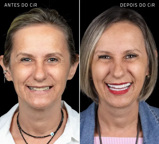 antes e depois maravilhoso depois dos implantes e lentes de contato dentais de paciente mulher de 50 anos no cir hospital odontológico lago sul park way