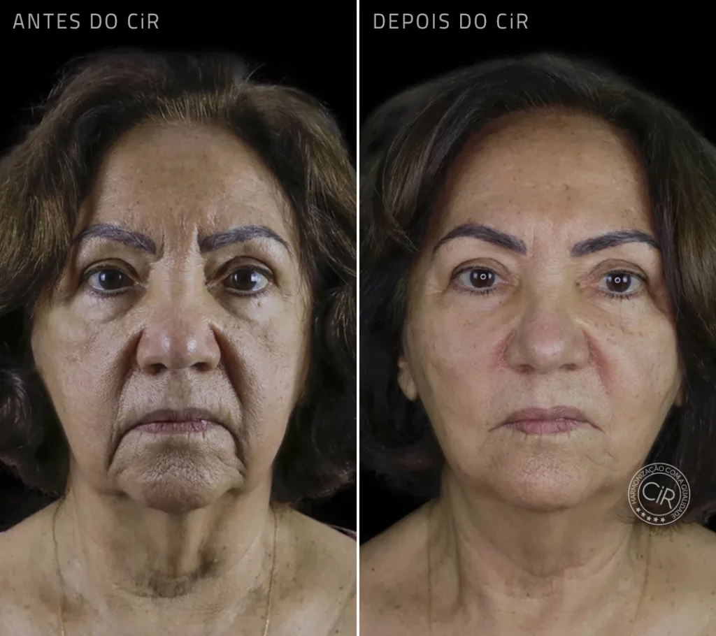 harmonização facial em paciente mulher de 78 anos full face realizado no cir brasília atendemos lago sul lago norte sudoeste noroeste parkway